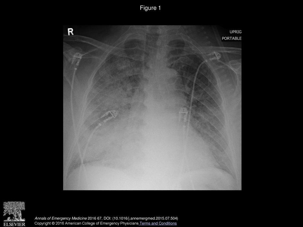 Figure 1 Anteroposterior portable chest radiograph demonstrated bilateral pulmonary edema.