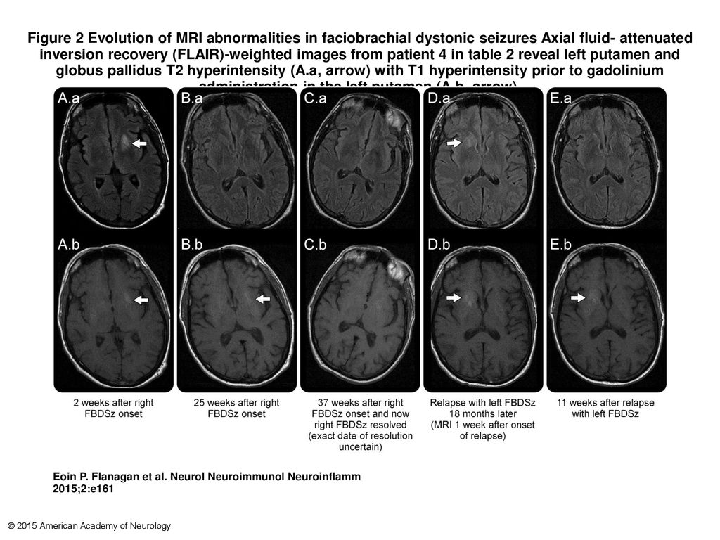 Figure 2 Evolution of MRI abnormalities in faciobrachial dystonic seizures Axial fluid- attenuated inversion recovery (FLAIR)-weighted images from patient 4 in table 2 reveal left putamen and globus pallidus T2 hyperintensity (A.a, arrow) with T1 hyperintensity prior to gadolinium administration in the left putamen (A.b, arrow).