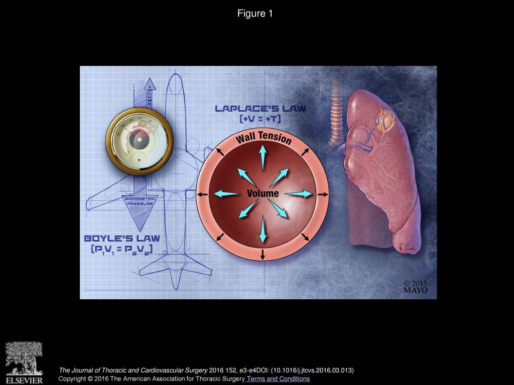 Figure 1 Boyle s and Laplace s laws as they apply to the pleural space during air travel.