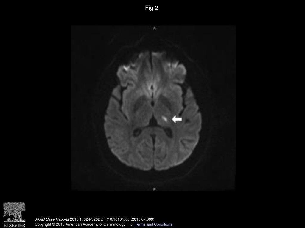 Fig 2 Diffusion-weighted magnetic resonance imaging of the brain shows lacunar infarct in the left thalamus (arrow).