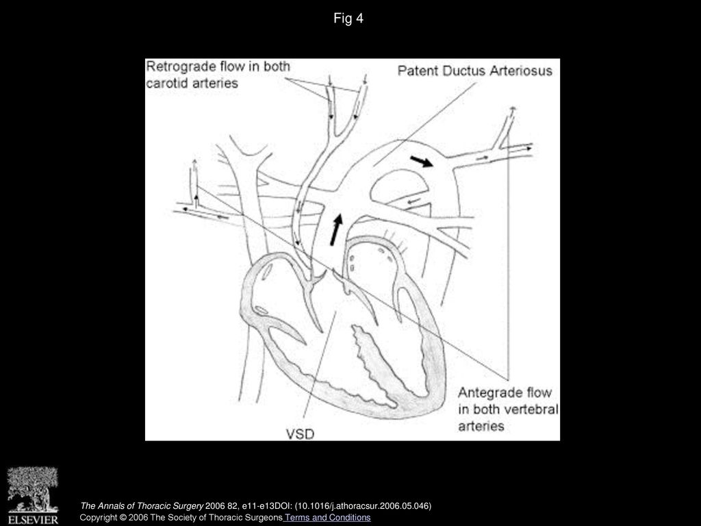 Fig 4 Preoperative diagram. Arrows indicate direction of blood flow. (VSD = ventricular septal defect.)