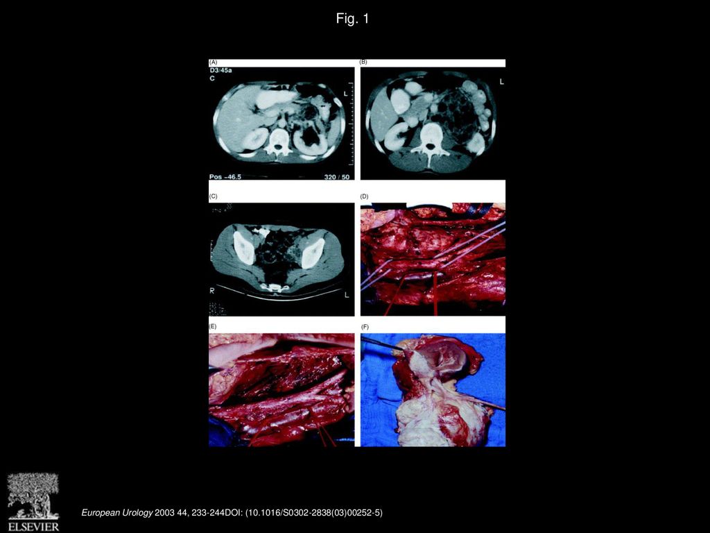 Fig. 1 Large retroperitoneal mass due to a growing teratoma.