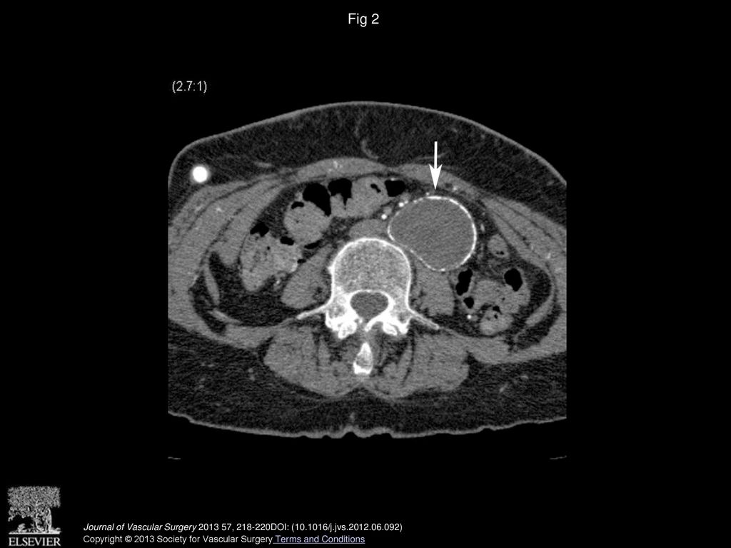 Fig 2 Postoperative computed tomography (CT) image shows the thrombosed abdominal aortic aneurysm (arrow).