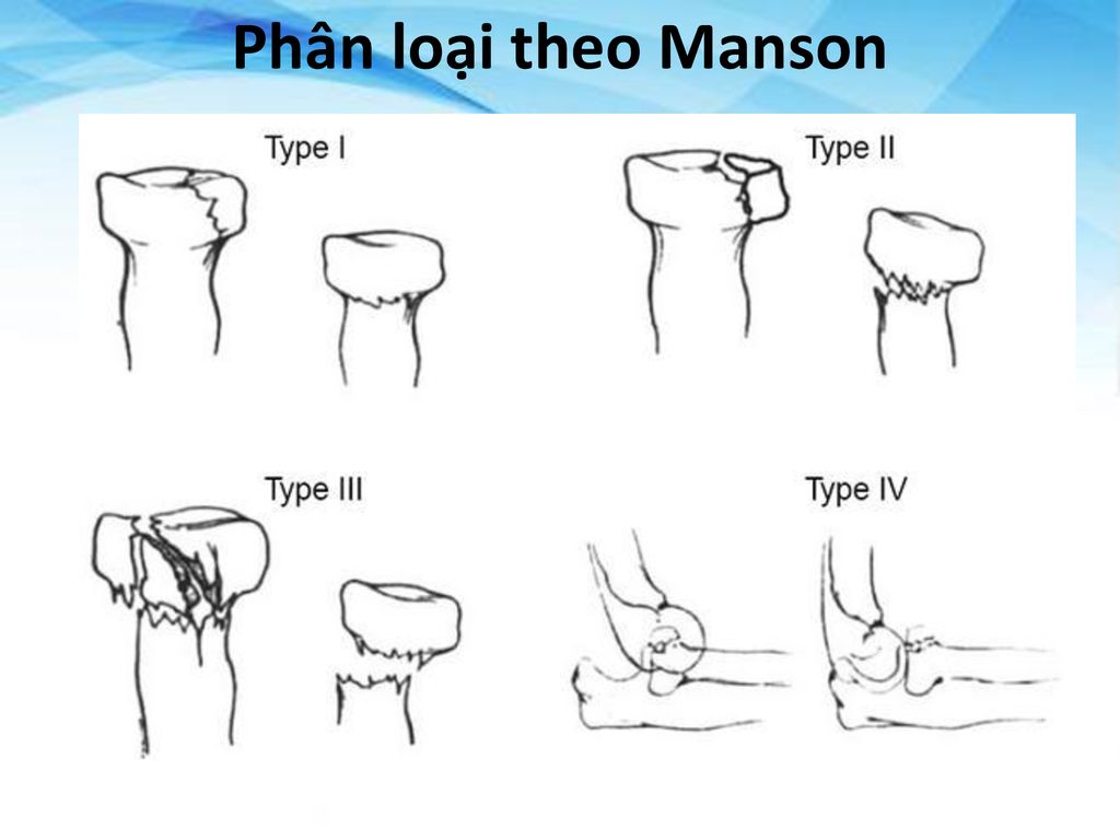 Bao Cao Một Ca điều Trị Gay đai Quay Bằng Xuyen đinh Kirschner C Arm Ppt Download