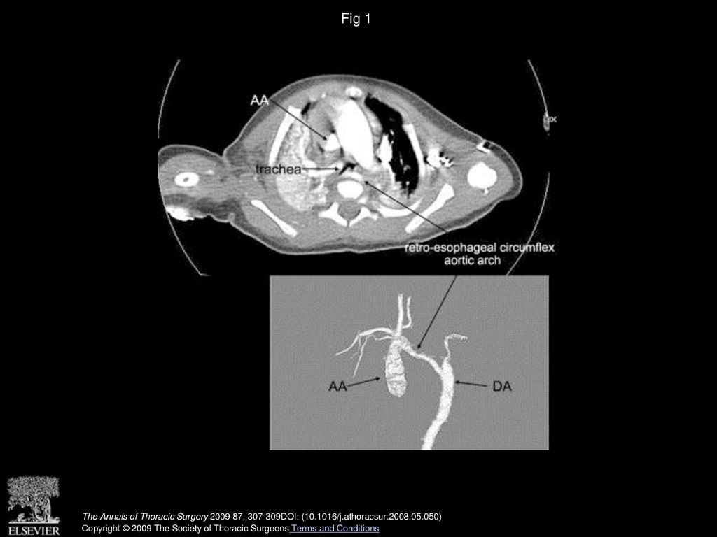Fig 1 Preoperative cardiac computed tomographic images. (AA = ascending aorta; DA = descending aorta.)