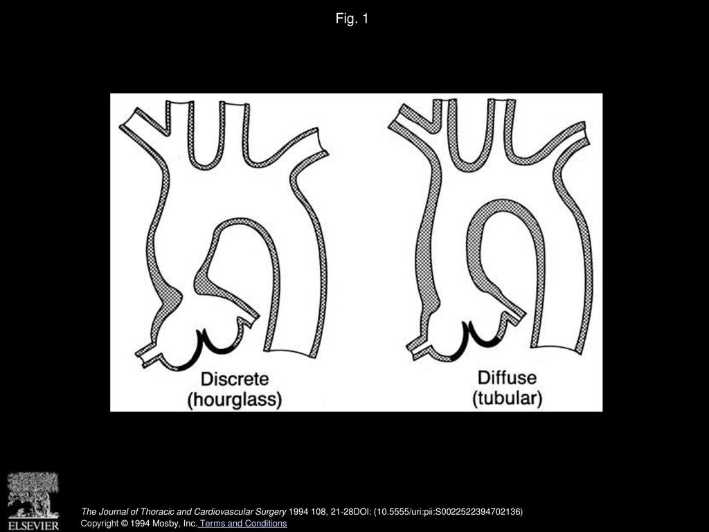 Fig. 1 Schematic diagram of discrete and diffuse forms of supravalvular aortic stenosis.