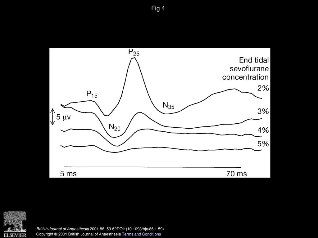 Fig 4 Sample traces of one subject. The increase in P15-N20 amplitude is clearly seen as the other amplitudes decrease.