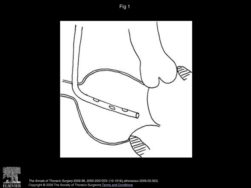 Fig 1 Positioning vent catheter for advancement over J-shaped stylet in Seldinger-type movement.