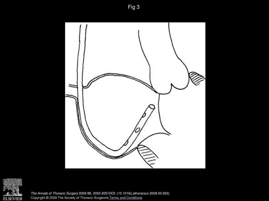 Fig 3 Advancement of vent catheter and stylet together, posterior bowing, and bypassing of mitral valve.