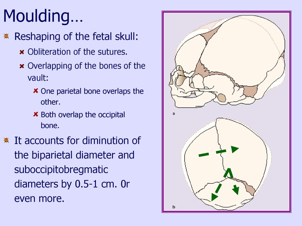 Moulding… Reshaping of the fetal skull: