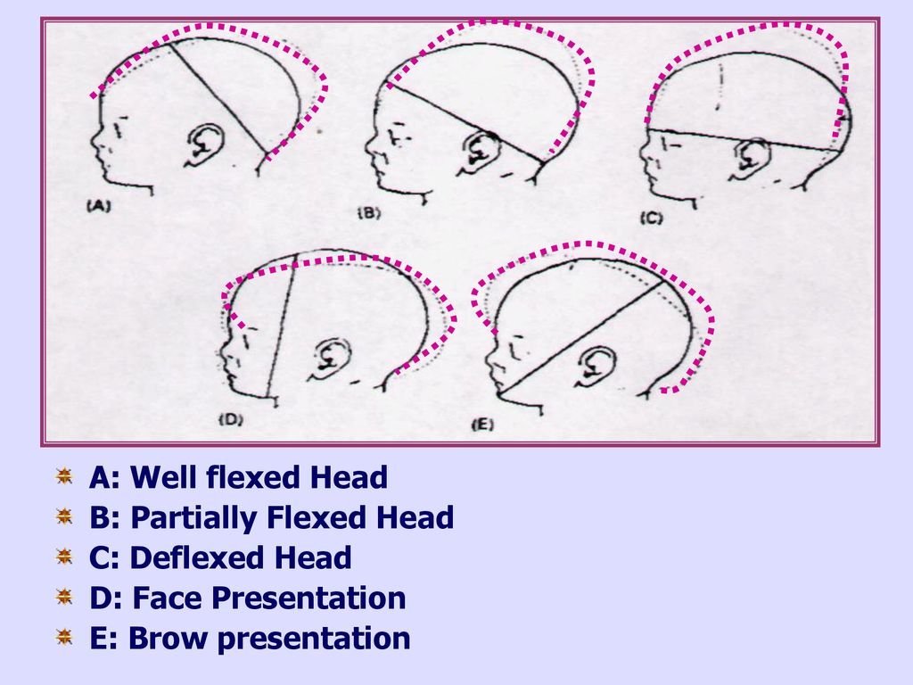 A: Well flexed Head B: Partially Flexed Head. C: Deflexed Head.