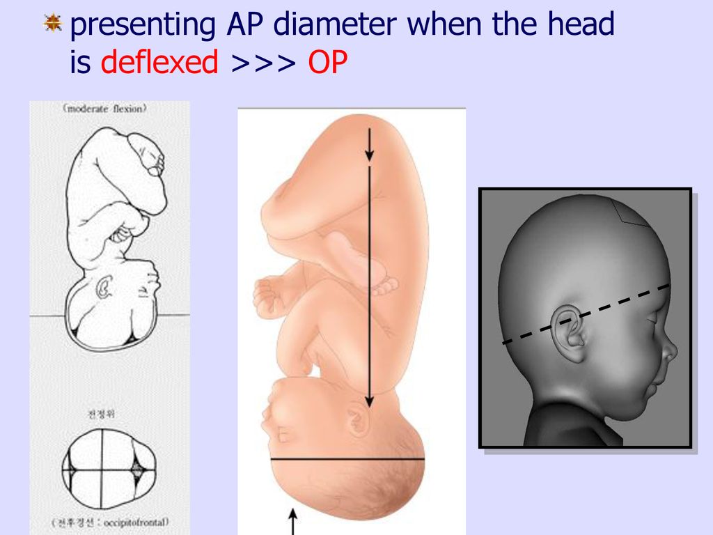 presenting AP diameter when the head is deflexed >>> OP