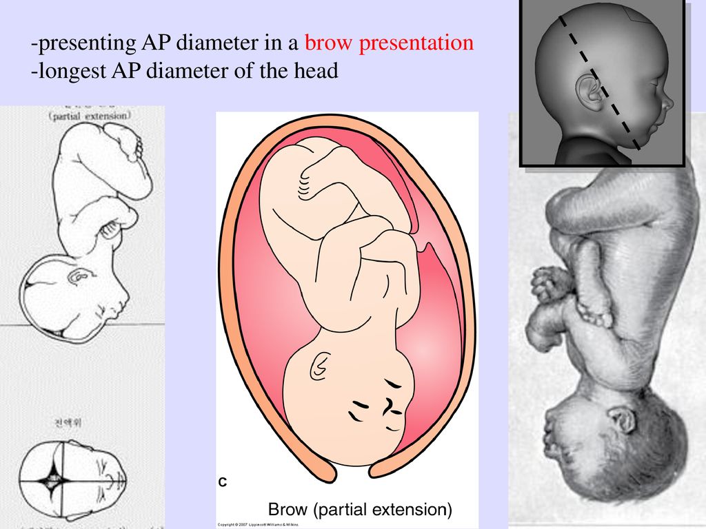 presenting AP diameter in a brow presentation