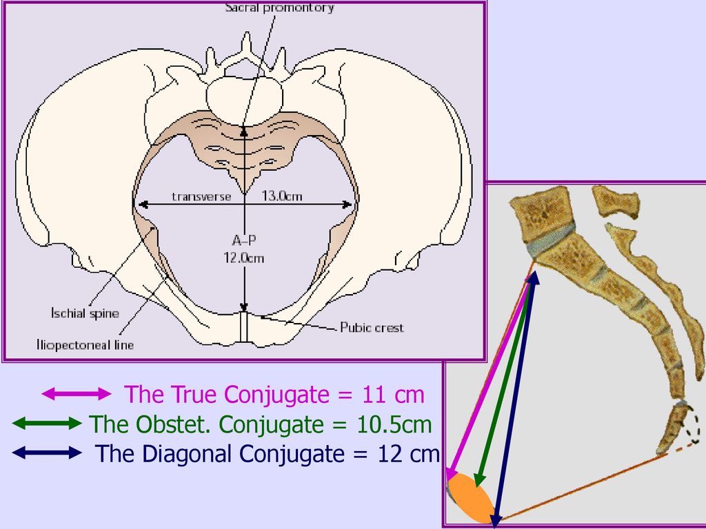 The Diagonal Conjugate = 12 cm The Obstet. Conjugate = 10.5cm