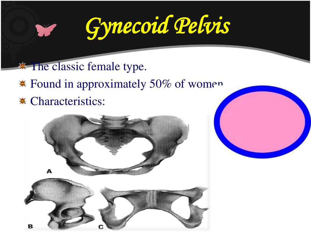 Gynecoid Pelvis The classic female type.