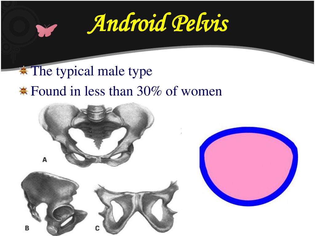 Android Pelvis The typical male type Found in less than 30% of women