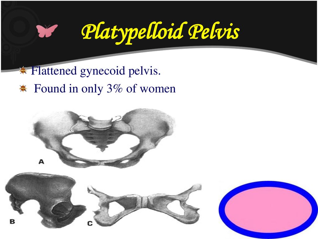 Platypelloid Pelvis Flattened gynecoid pelvis.