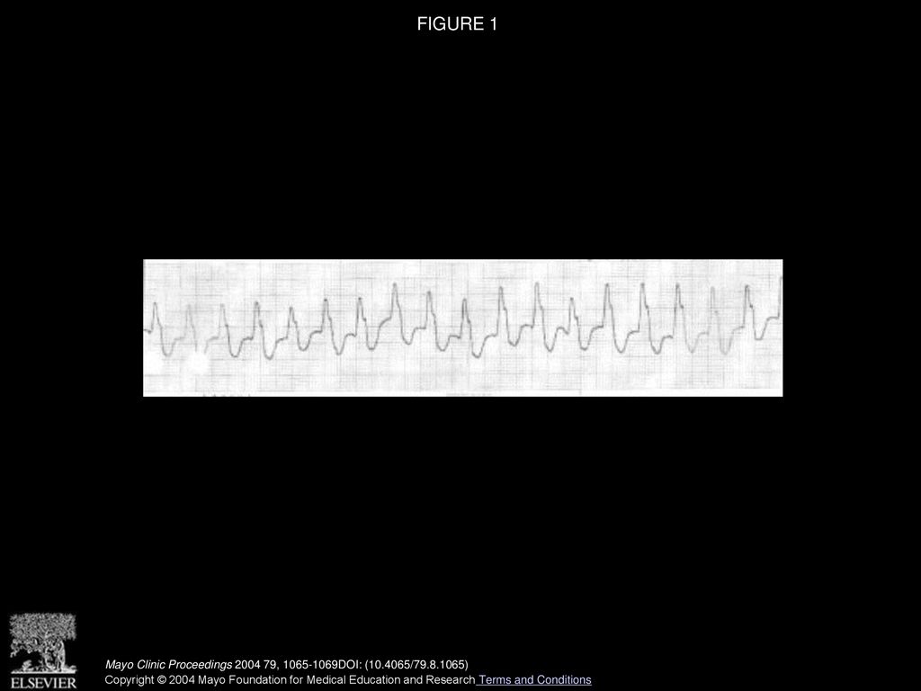 FIGURE 1 Initial electrocardiogram showing monomorphic ventricular tachycardia. Mayo Clinic Proceedings , DOI: ( / )
