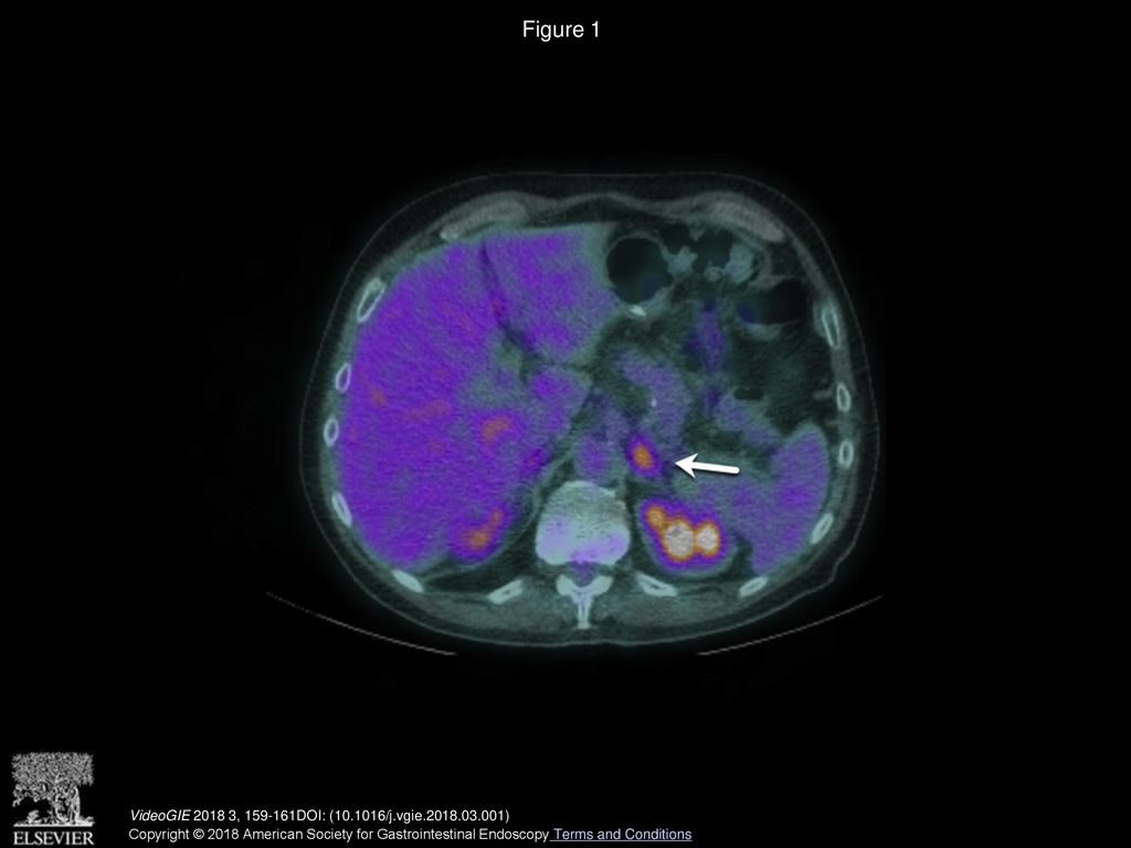 Figure 1 Positron emission tomographic CT image showing increased 18F-fluorodeoxyglucose uptake in left adrenal gland (white arrow).