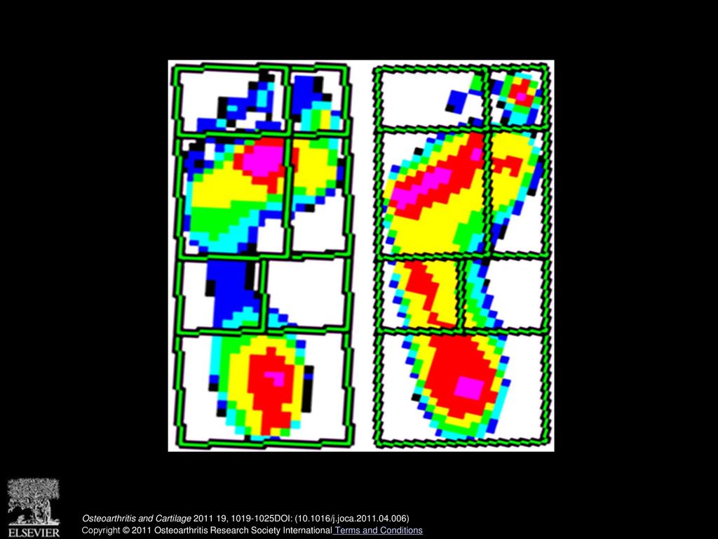 Supplementary Figure 1: Representative stance phase peak pressure indicates higher pressures (pink, red and yellow areas) in the patient with midfoot arthritis on the right, compared to the lower loads or unloaded areas (blue and green areas) in the control subject on the left.