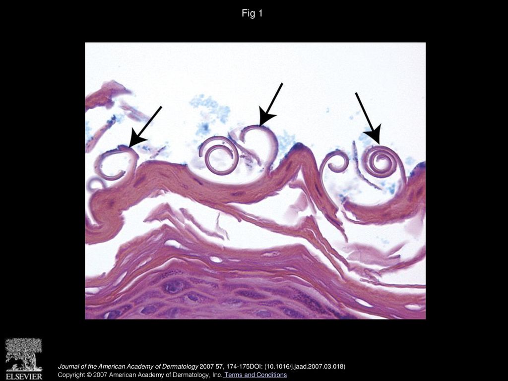 Pink pigtails are a clue for the diagnosis of scabies ppt download