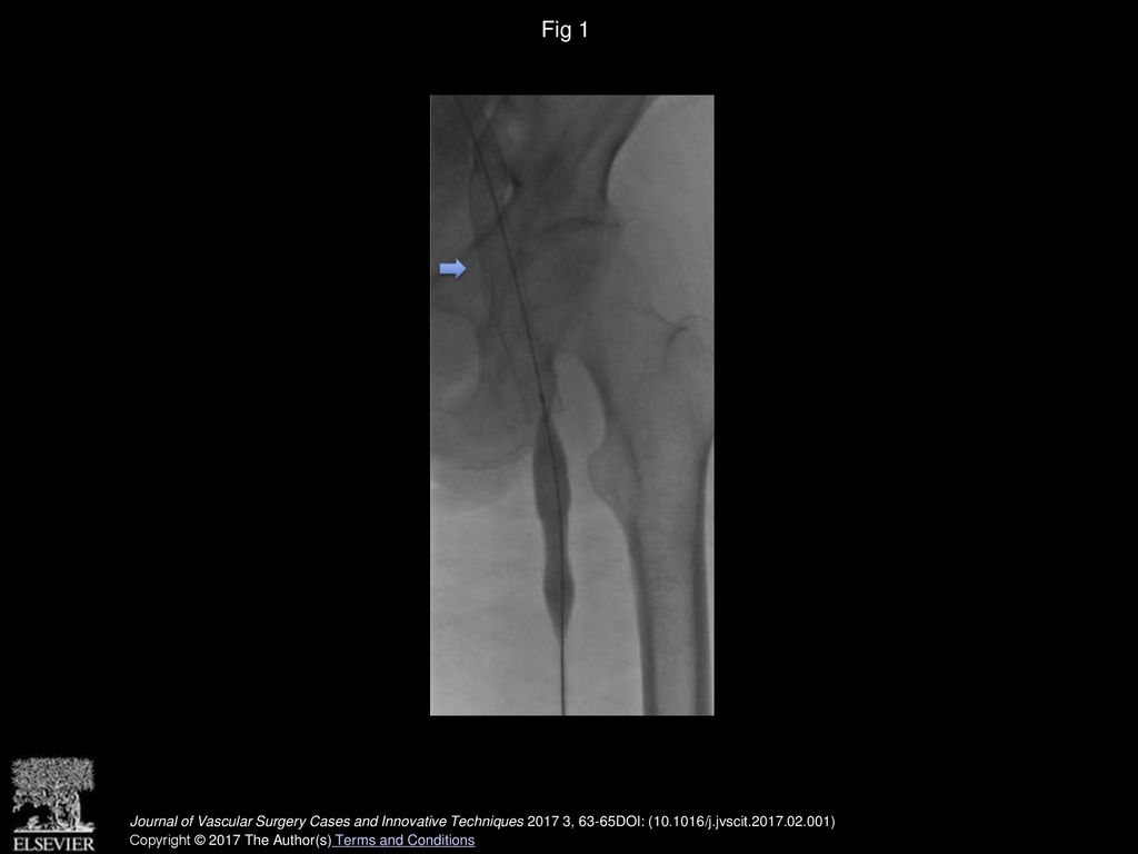 Fig 1 Initial fluoroscopic image after placement of left external iliac/common femoral vein stent (arrow).