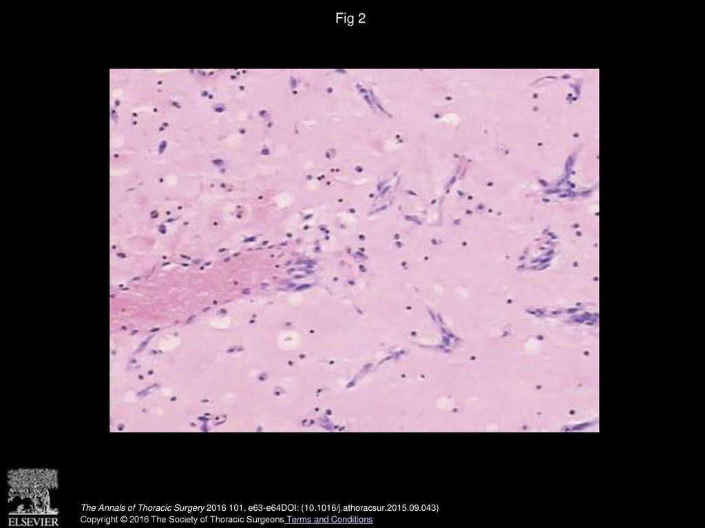 Fig 2 Histopathologic examination confirms the diagnosis of cardiac myxoma. (Hematoxylin and eosin, ×100.)