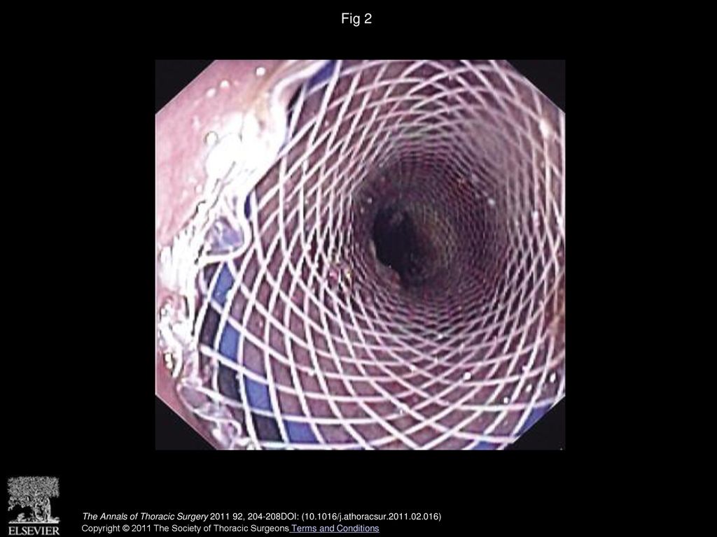 Fig 2 Endoscopic view of a partial dehiscence of an intrathoracic esophagogastrostomy after esophagectomy.