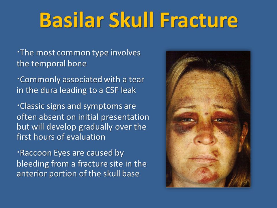 Signs of basilar skull fracture