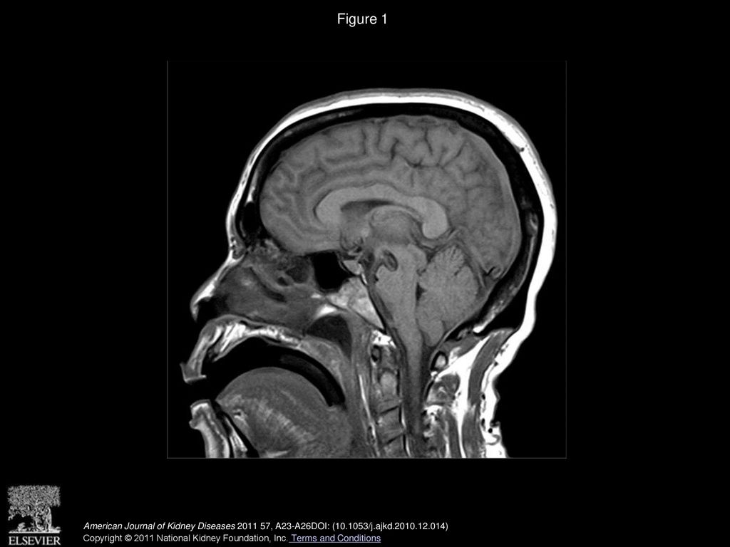 Figure 1 T1-weighted magnetic resonance image of the brain, sagittal section.