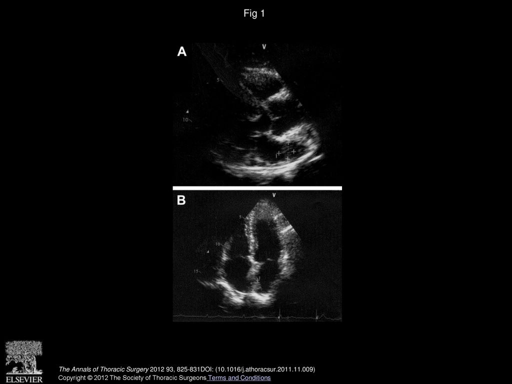 Fig 1 Echocardiographic appearance of left atrium myxoma attached to the interatrial septum. (A) Short axis view. (B) Four chamber view.