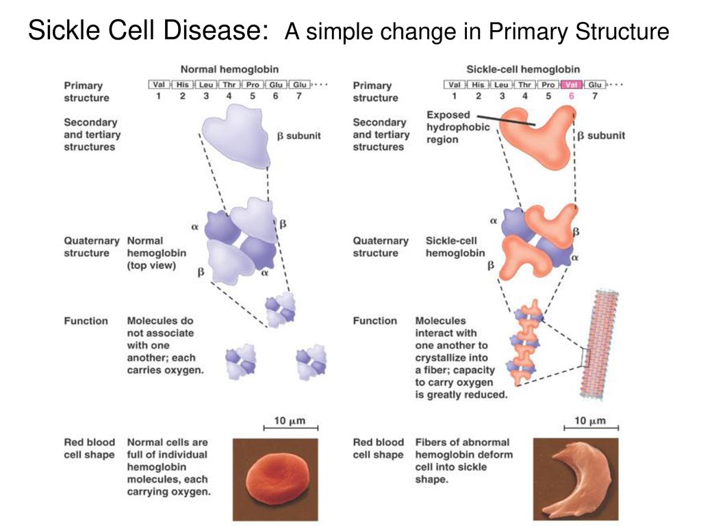 Sickle Cell Disease: A simple change in Primary Structure