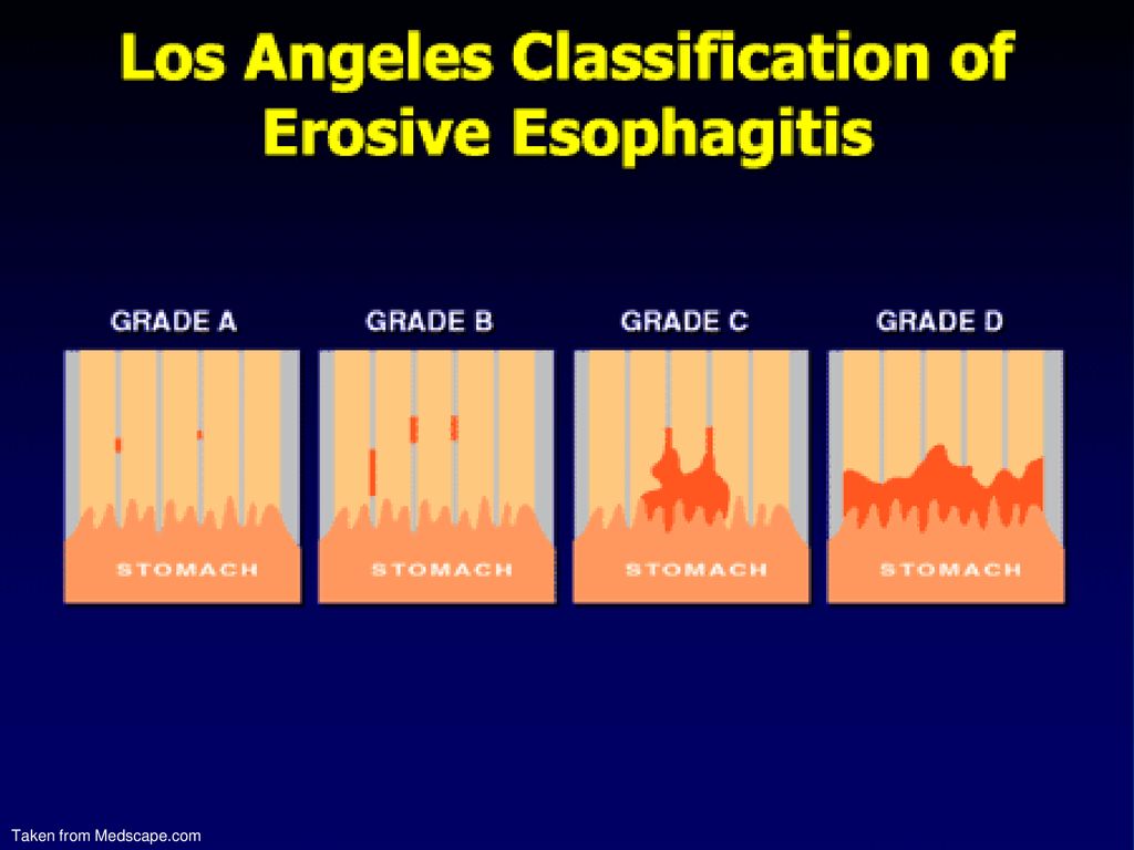 Лос анджелесская классификация эзофагитов