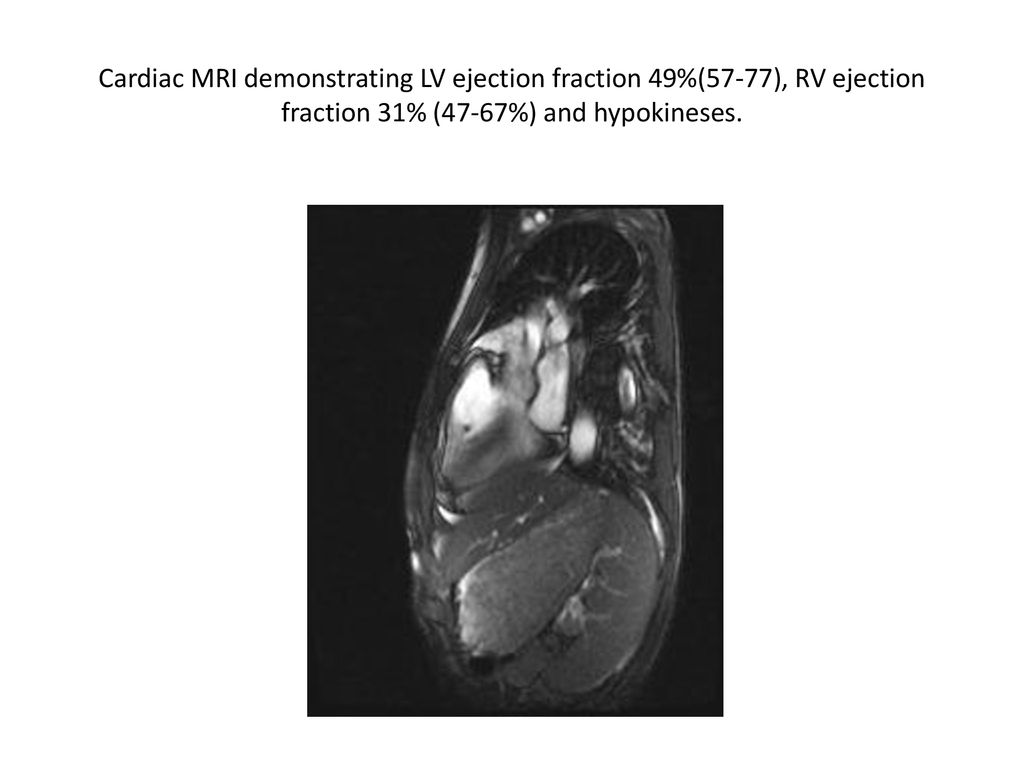 Cardiac MRI demonstrating LV ejection fraction 49%(57-77), RV ejection fraction 31% (47-67%) and hypokineses.