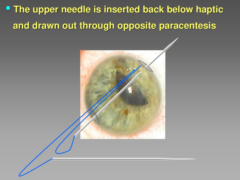 The upper needle is inserted back below haptic