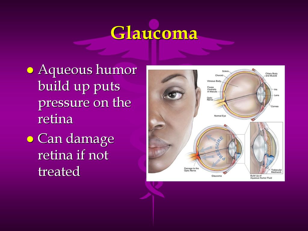 Glaucoma Aqueous humor build up puts pressure on the retina