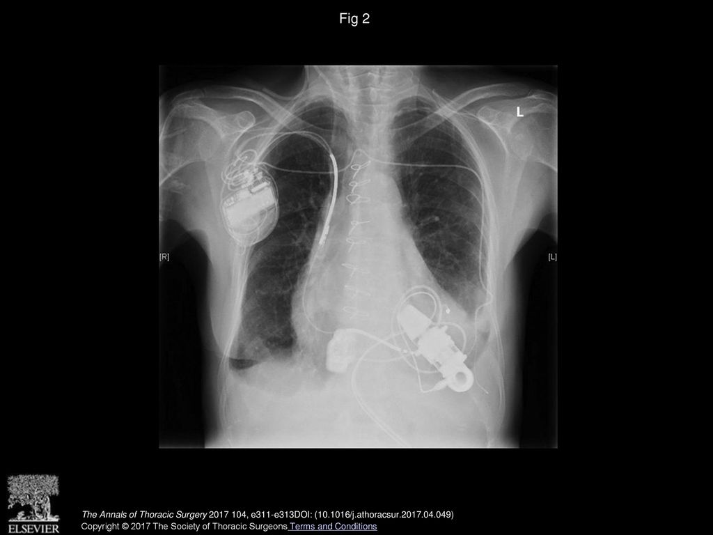 Fig 2 Postoperative chest x-ray after aVAD (ReliantHeart Inc, Houston, TX) implantation.