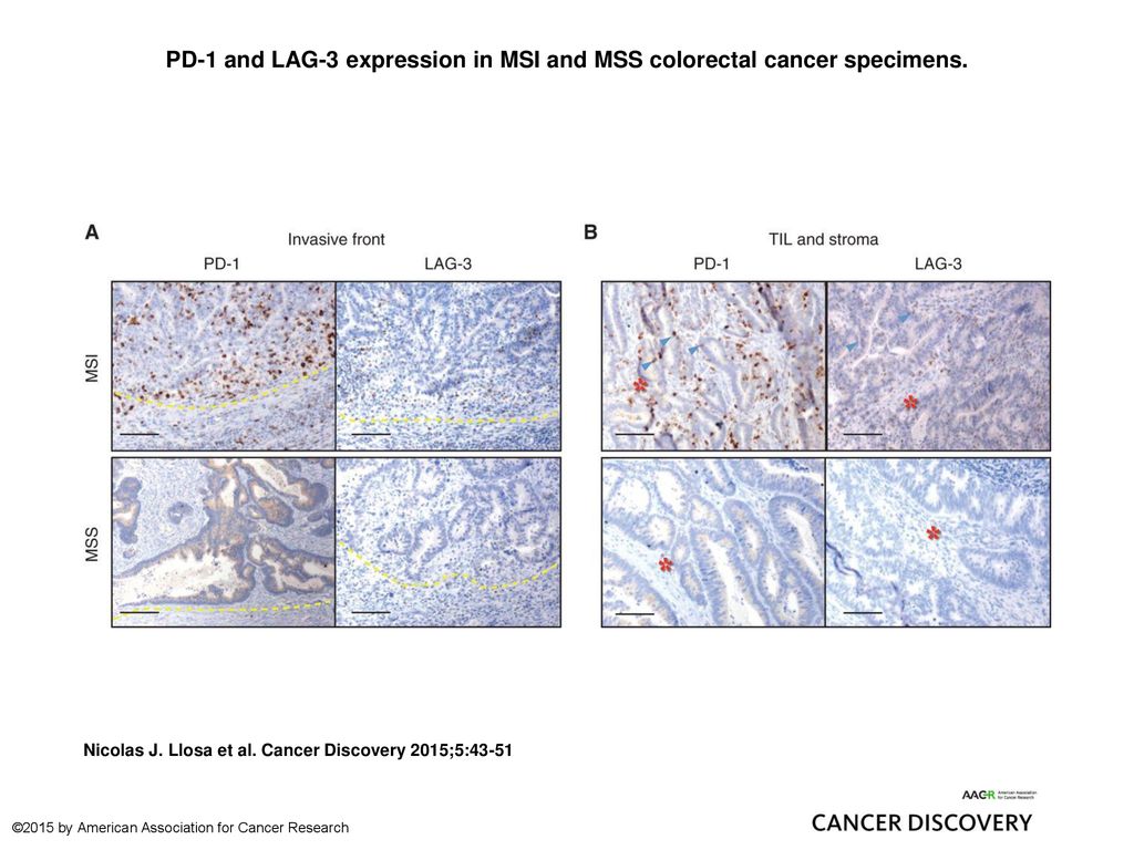 PD-1 and LAG-3 expression in MSI and MSS colorectal cancer specimens.