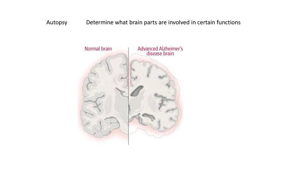 Autopsy Determine what brain parts are involved in certain functions