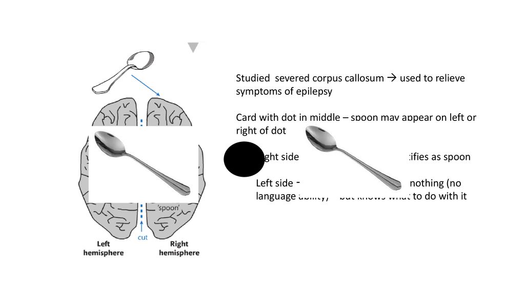 Studied severed corpus callosum  used to relieve symptoms of epilepsy