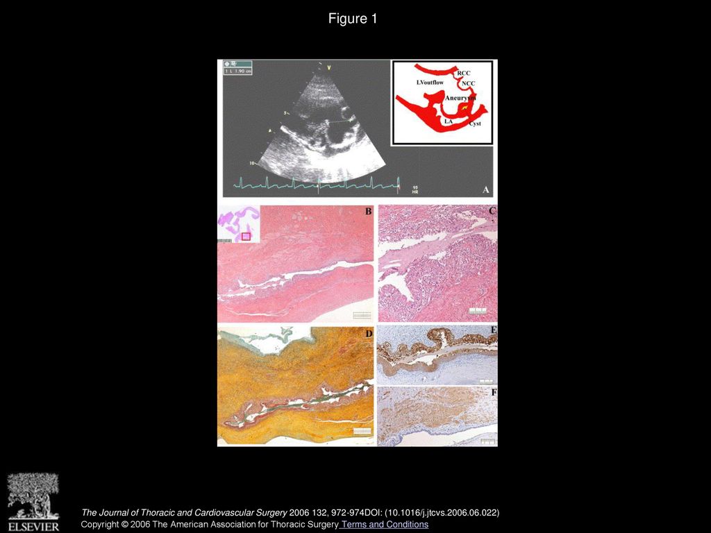 Bronchogenic cyst: Unexpected finding in a large aneurysm of the pars ...