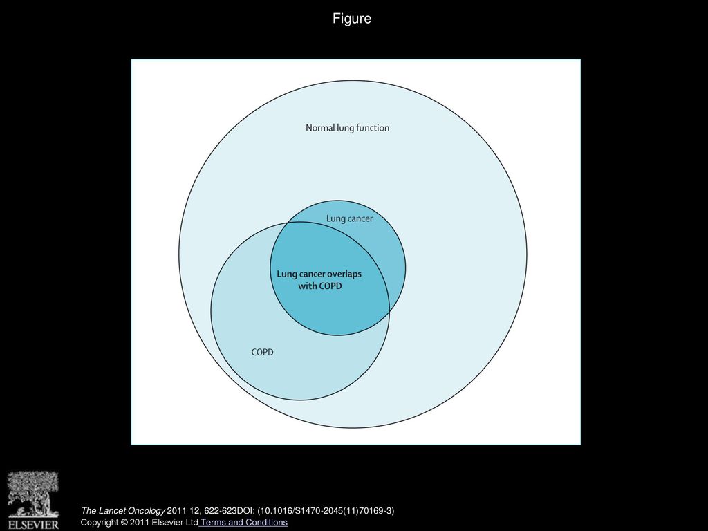 Figure Overlap of chronic obstructive pulmonary disease and lung cancer in smokers.