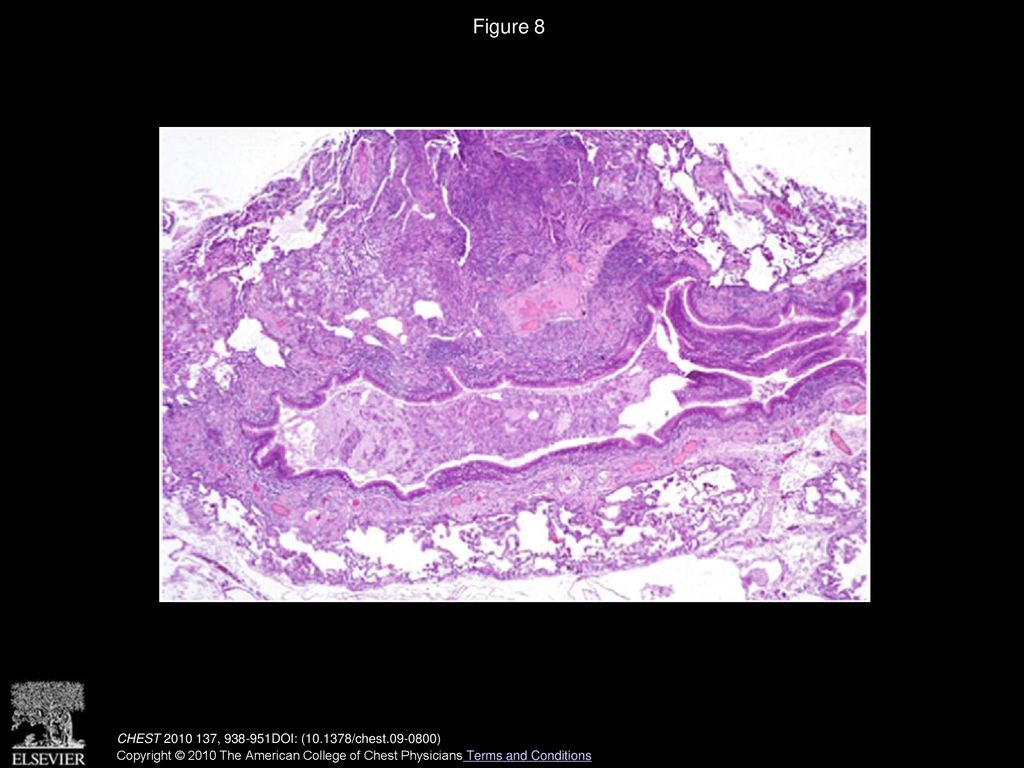 Bronchiolar Disorders Ppt Download