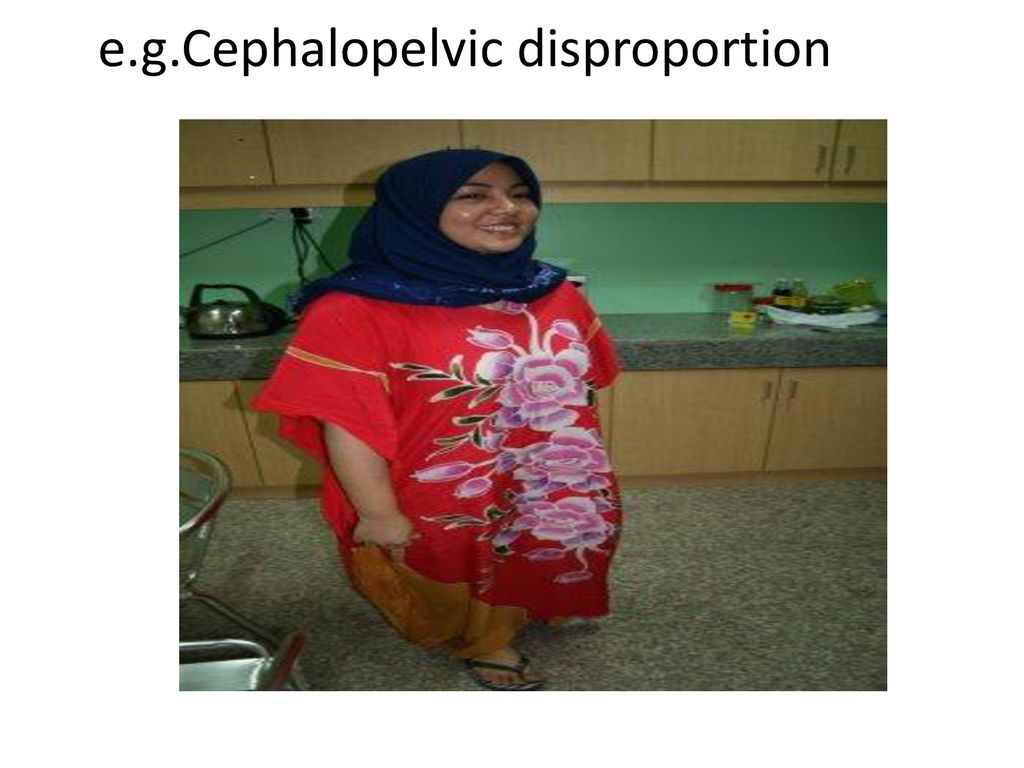 e.g.Cephalopelvic disproportion