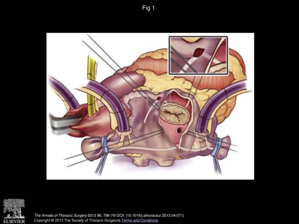 Fig 1 Right atrial lesion set.