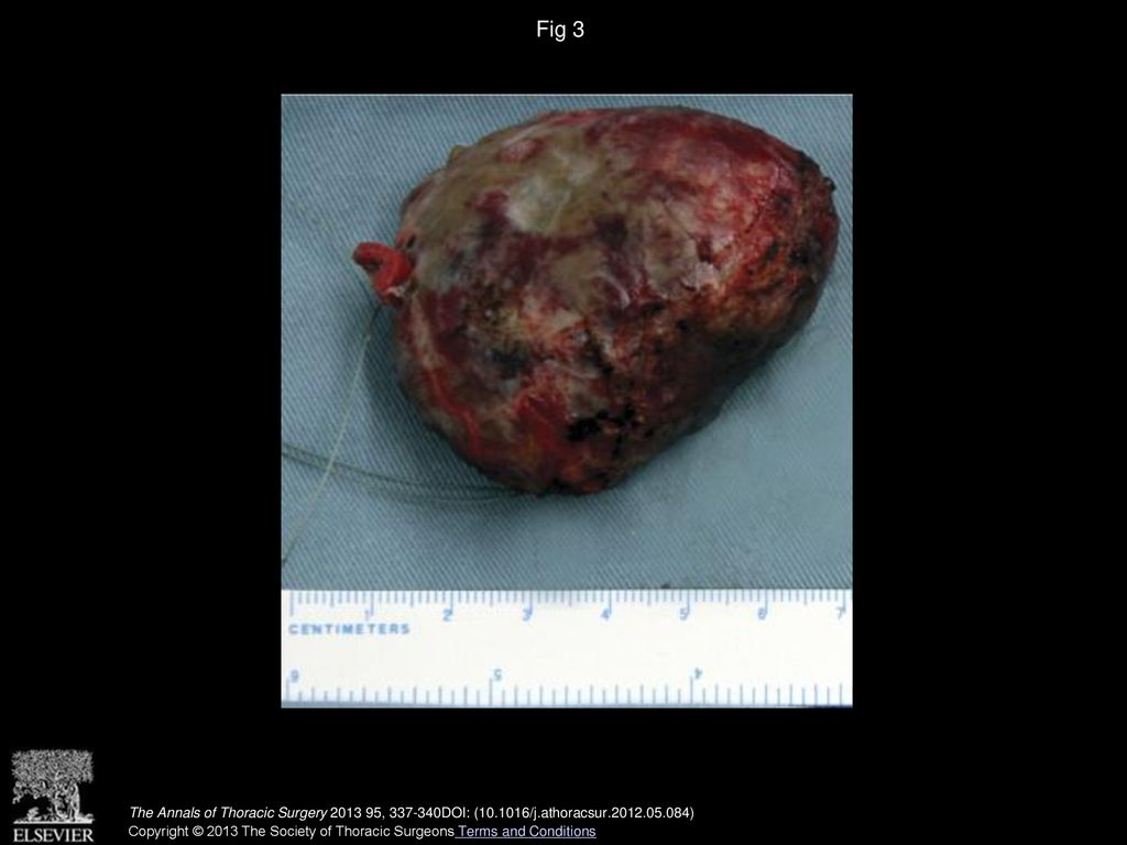 Fig 3 Resected cardiac pheochromocytoma.