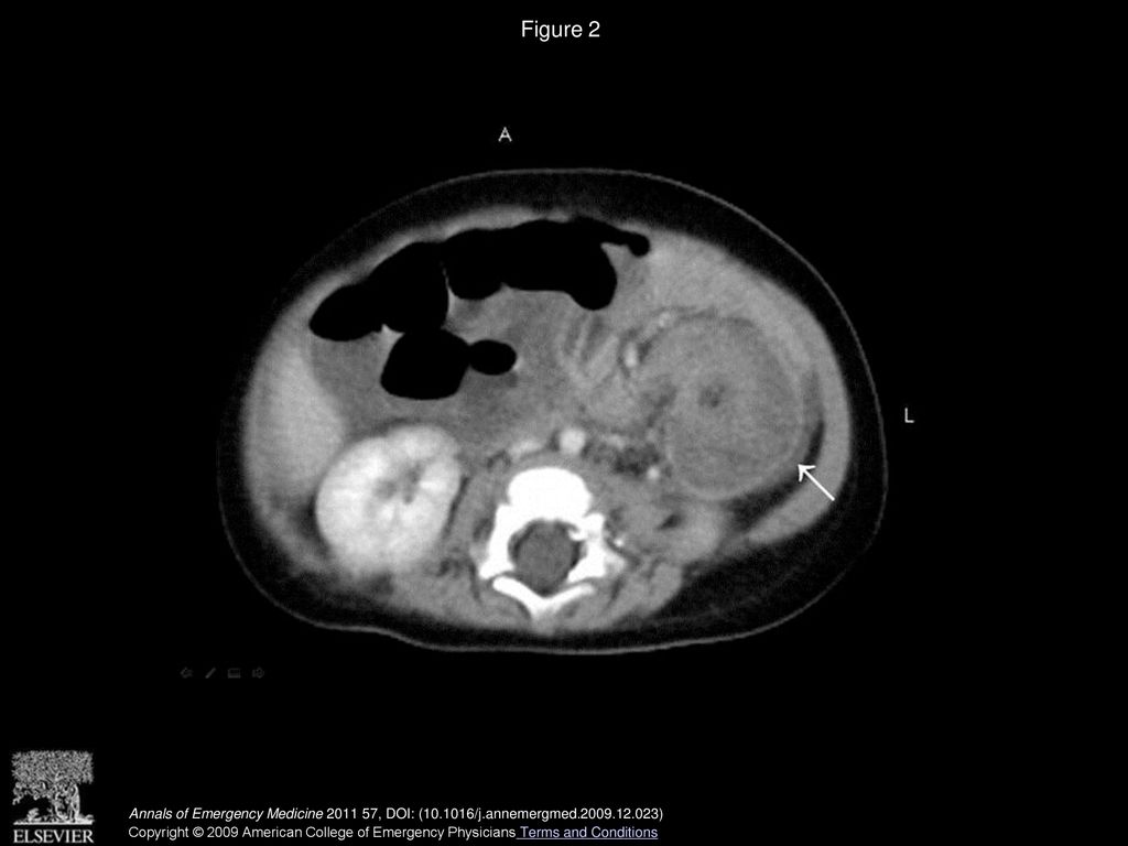 Figure 2 Abdominal CT scan.