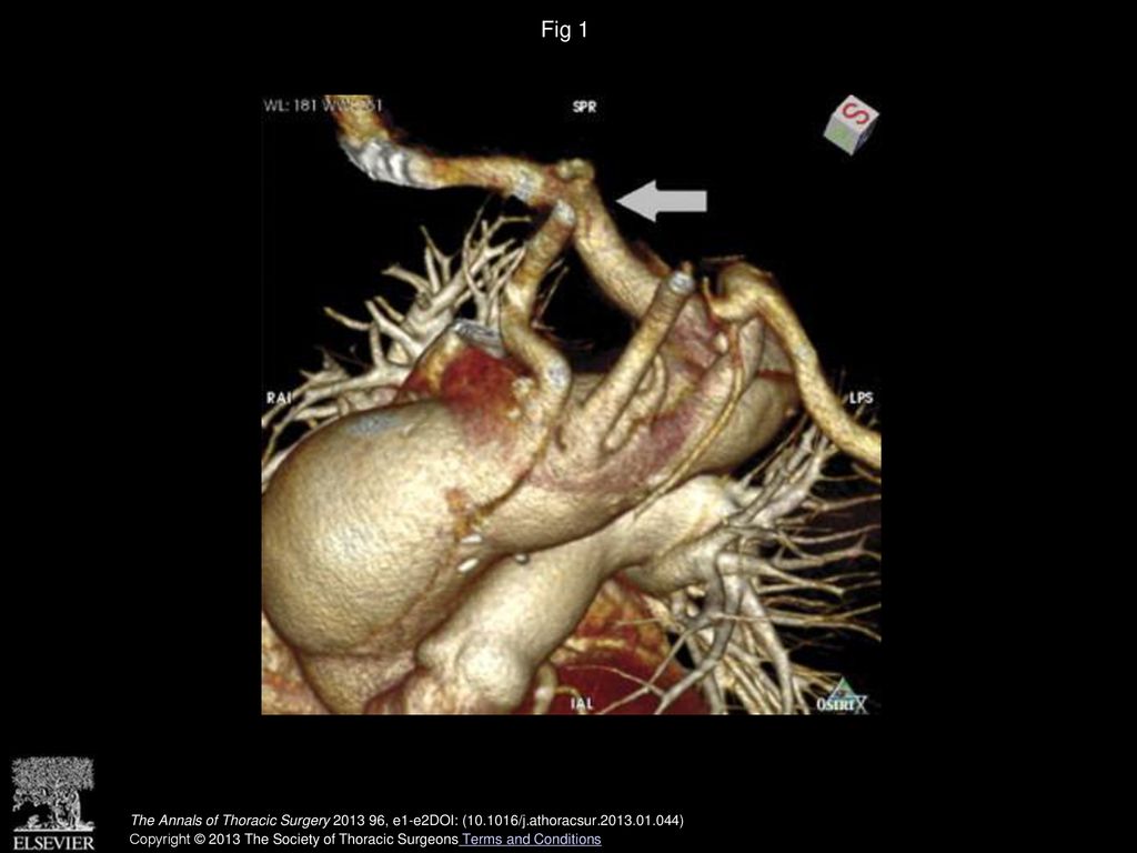 Fig 1 Computed tomography reveals aortic dissection and the aberrant right subclavian artery. Arrow indicates the aberrant right subclavian artery.