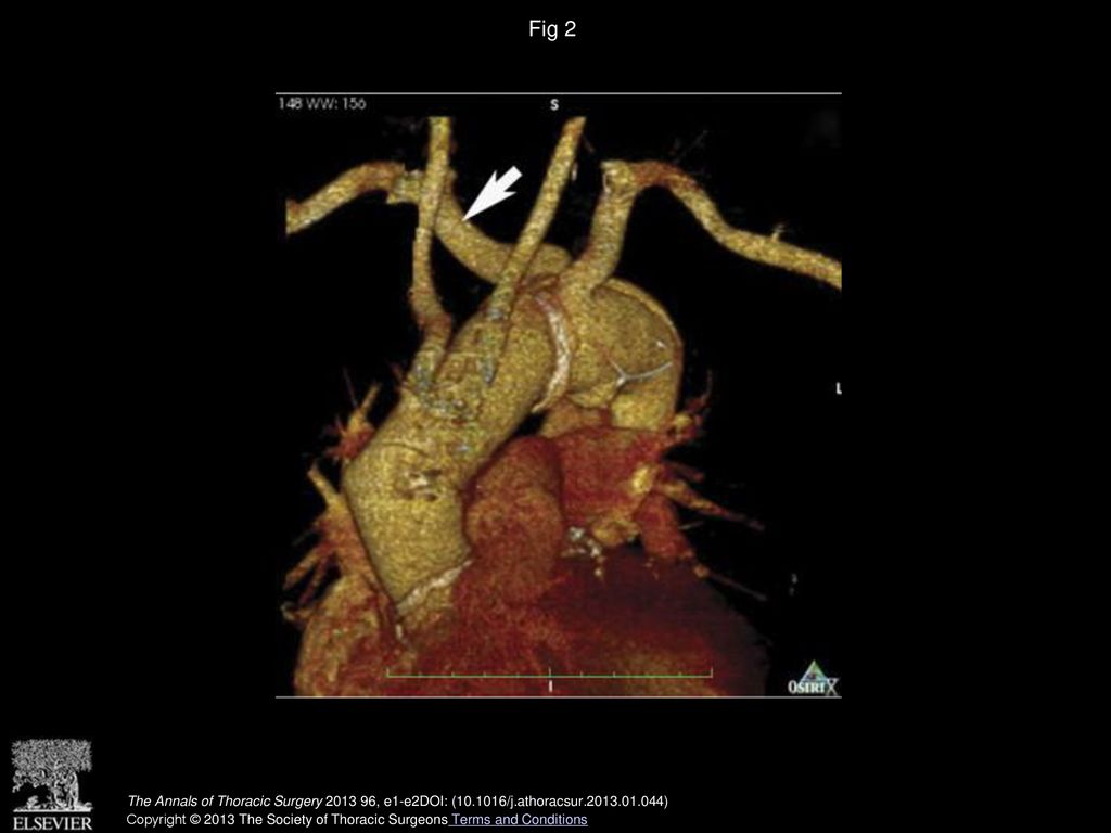 Fig 2 Control computed tomography. Arrow indicates the aberrant right subclavian artery.