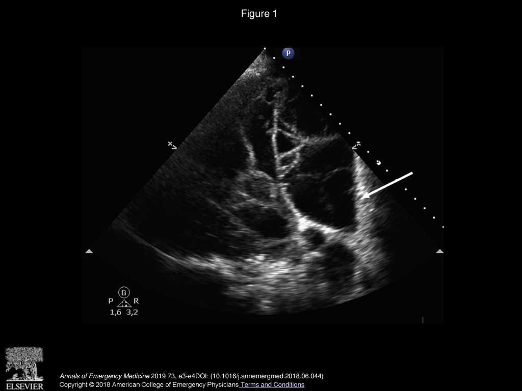 Figure 1 Thoracic ultrasonography showing multiloculated effusions with septations above the diaphragm (arrow).